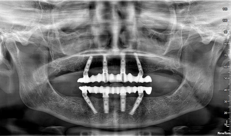 dental implant xray